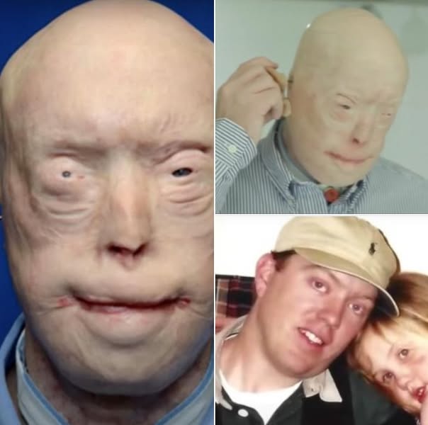 Firefighter suffers third-degree burns – this is him 7 years later