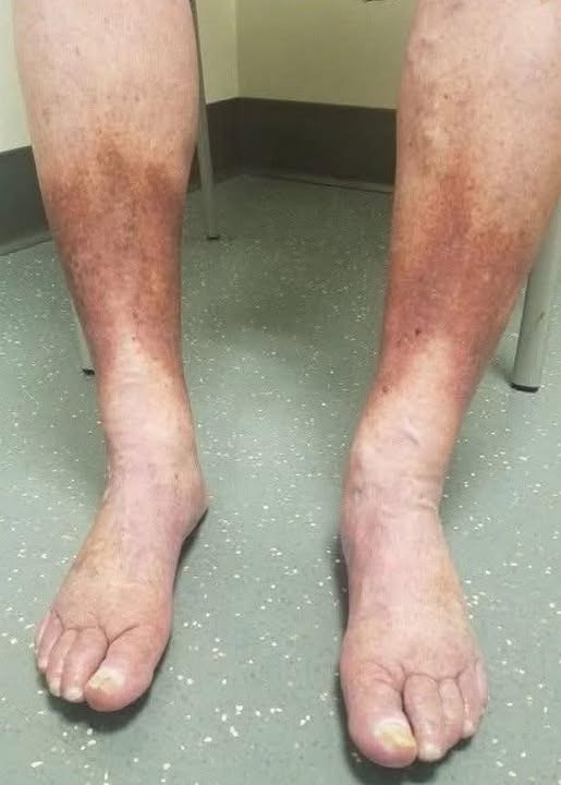 SAY GOODBYE TO VARICOSE