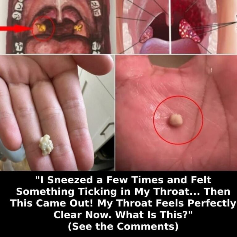 Here’s What You Need to Know About Tonsil Stones