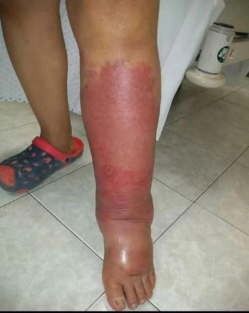 How I Got Rid of Swollen Ankles, Feet, and Legs — Without Medications