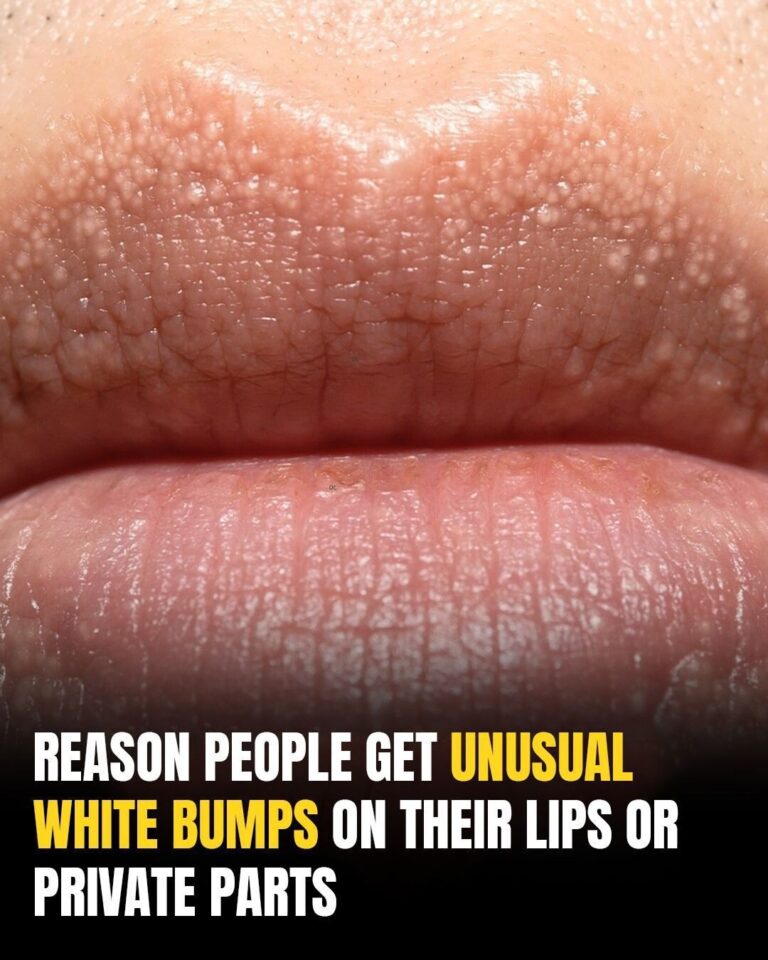 What Are Those White Bumps That Can Appear On Your Private Parts and What Causes Them?
