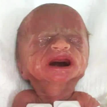 The amazing story of Tru Beare, born weighing just 1 pound