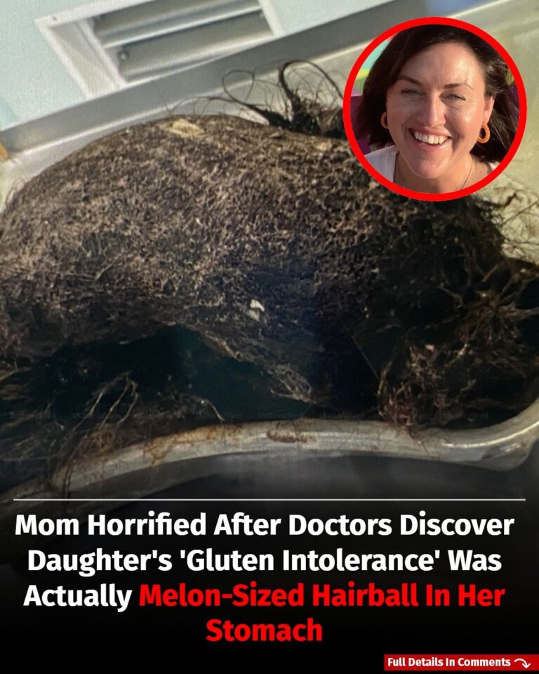 Mom Stunned After Doctors Find Massive Melon-Sized Hairball Causing Daughter’s ‘Gluten Intolerance’ Symptoms