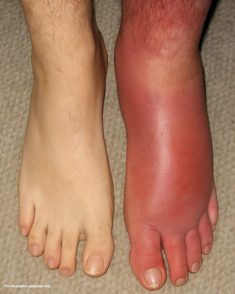 What Does It Mean When One Leg Suddenly Becomes Red and Swollen?