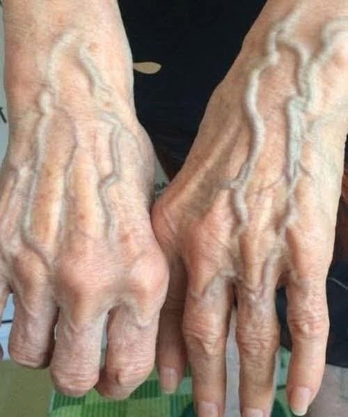 When to Worry About Veins That Appear Out of Nowhere