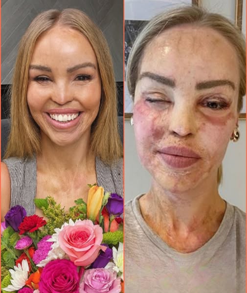 Katie Piper’s Triumph: 17 Years After Acid Attack, She Stuns the World in a Blue Bikini