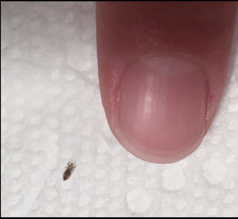 Head lice: How to get rid of them and stop them coming back