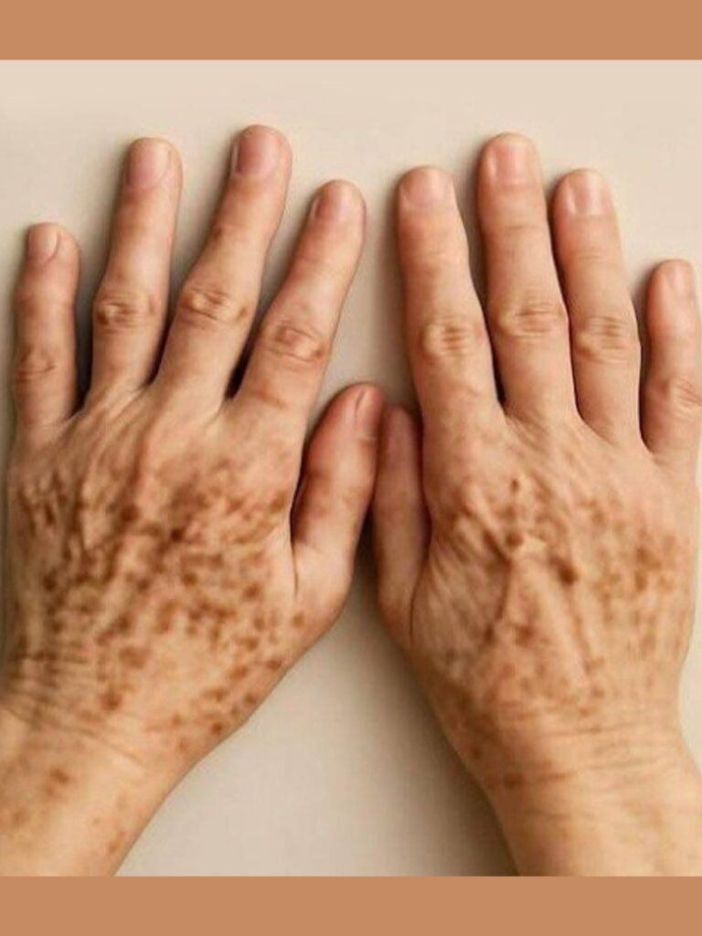 🖐️ Spots on the Hands: Are They Signs of Melanoma — The Most Dangerous Form of Skin Cancer?