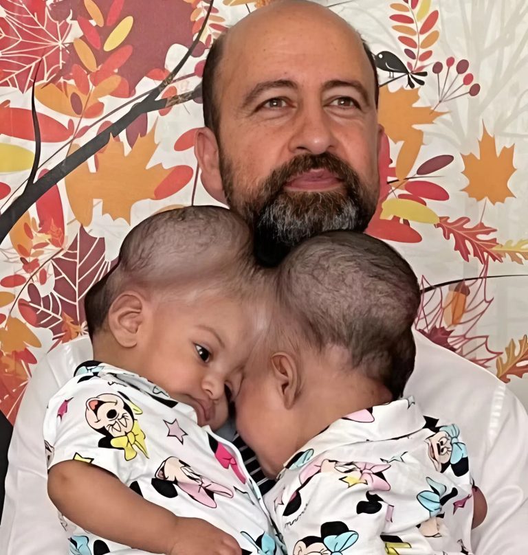 The sisters were born conjoined, sharing one head, but at age three, doctors successfully performed surgery to separate them, giving each child a chance at an independent life.