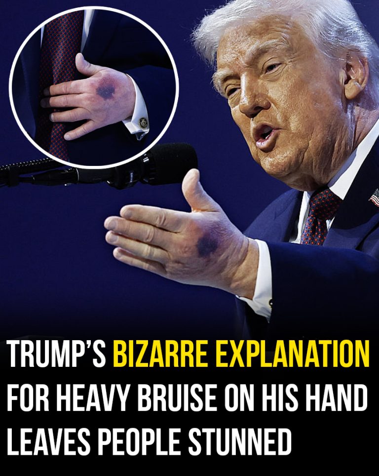 Trump explains the heavy bruise on his left hand came from ‘clipped it on the table’